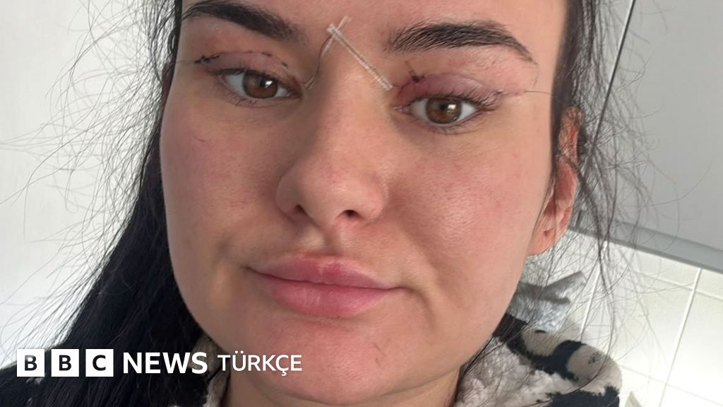 Açık yaralar ve kapanmayan gözler: Kadınlar ucuz göz kapağı ameliyatı konusunda uyarıyor