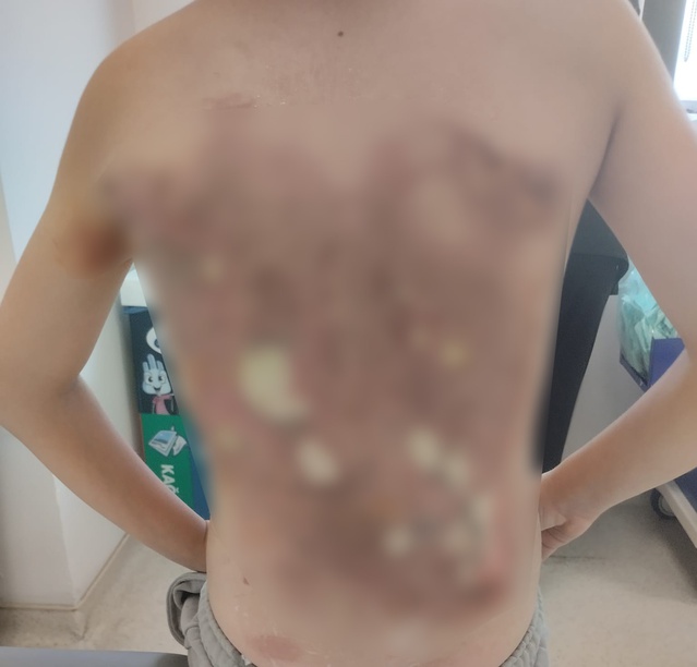 Arnavutköy'de akran zorbalığı iddiası: 12 yaşındaki çocuğun sırtını kolonya ile yaktılar