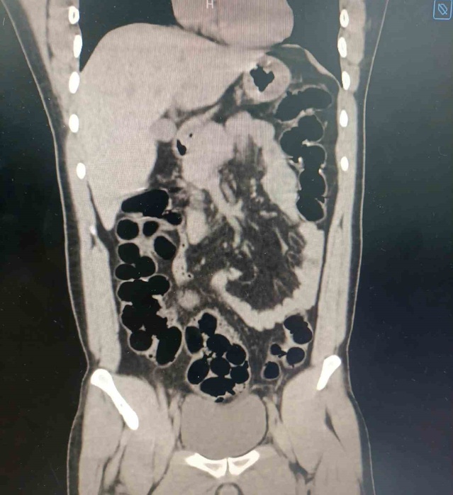 İran uyruklu şahsın midesinde 943,77 gram eroin bulundu, Bolu'da tutuklandı