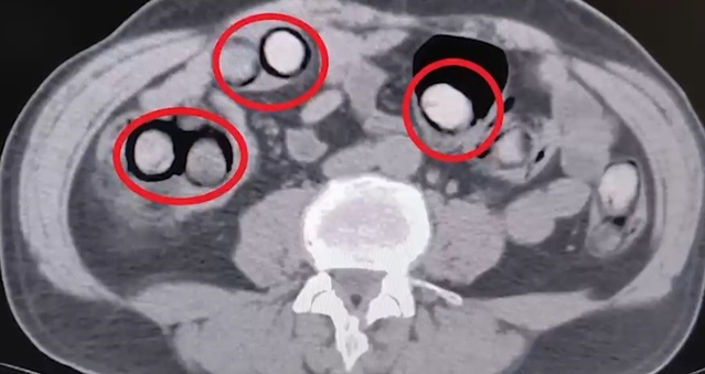 Tatvan'da yabancı uyruklu yolcu vücudunda 758 gram metamfetaminle yakalanıp tutuklandı