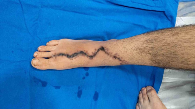 13 yaşındaki Baran'ın kıyma makinesinde kaybettiği başparmağının yerine ayak parmağı kondu