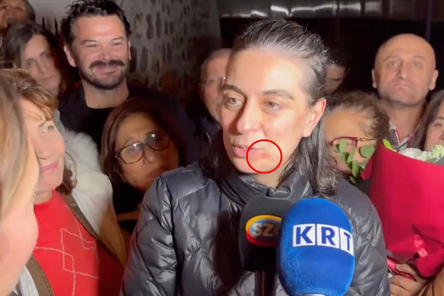 Sinem Dedetaş'ın dudağının kenarındaki kızarıklığın nedeni belli oldu